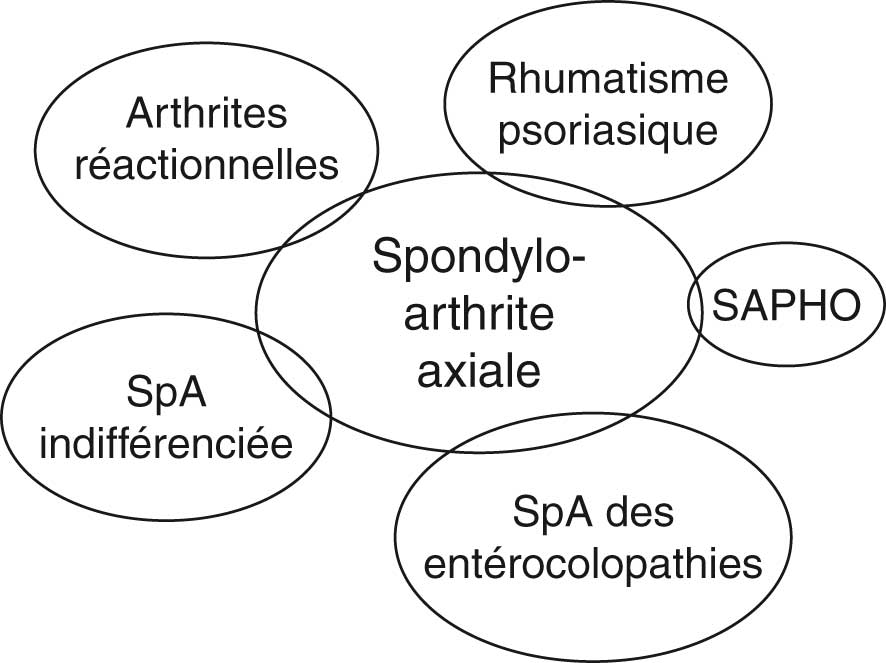 Spondyloarthrite