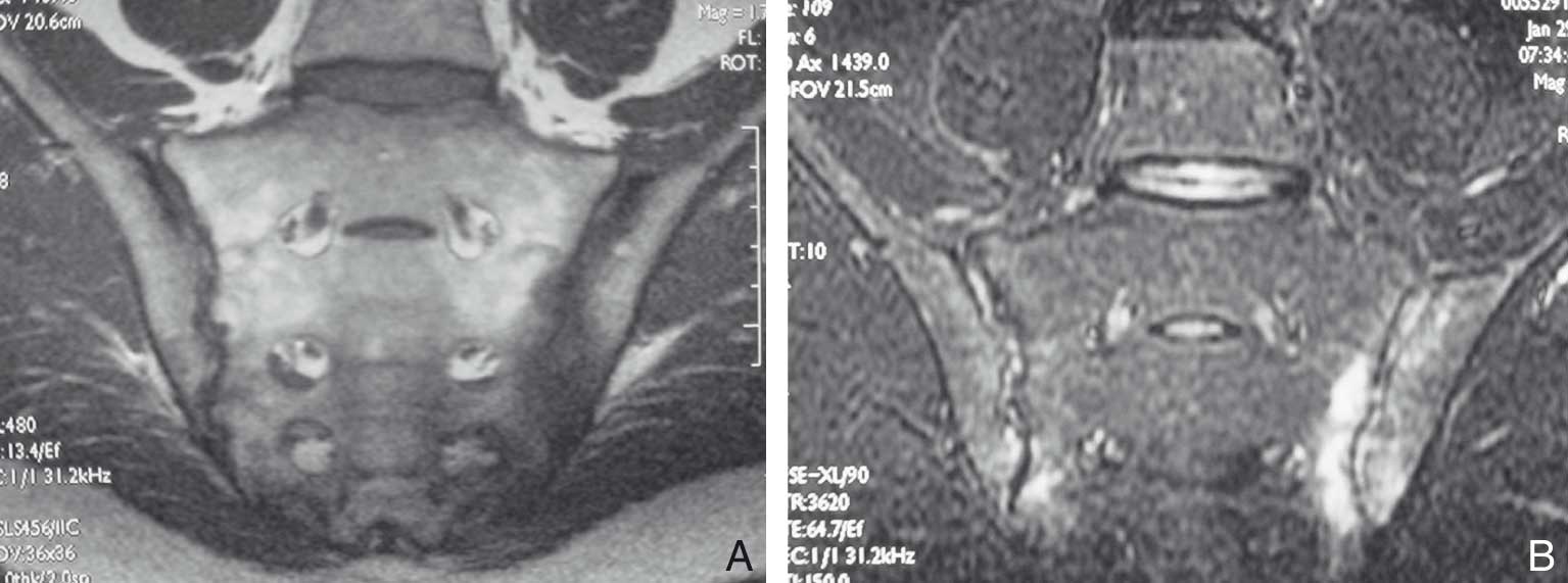 Figure Figure 3-Traitement chirurgical des lésions sacro-iliaques