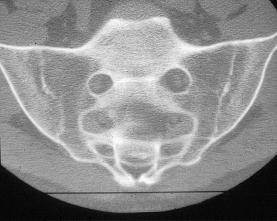 Spondyloarthrite
