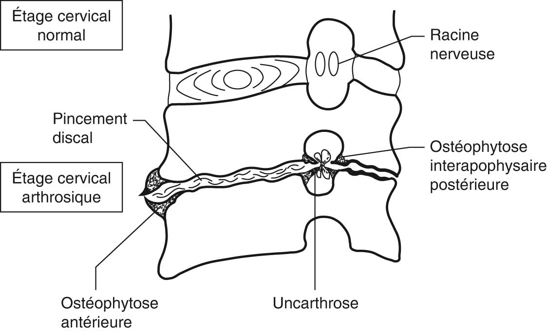 Rachialgies