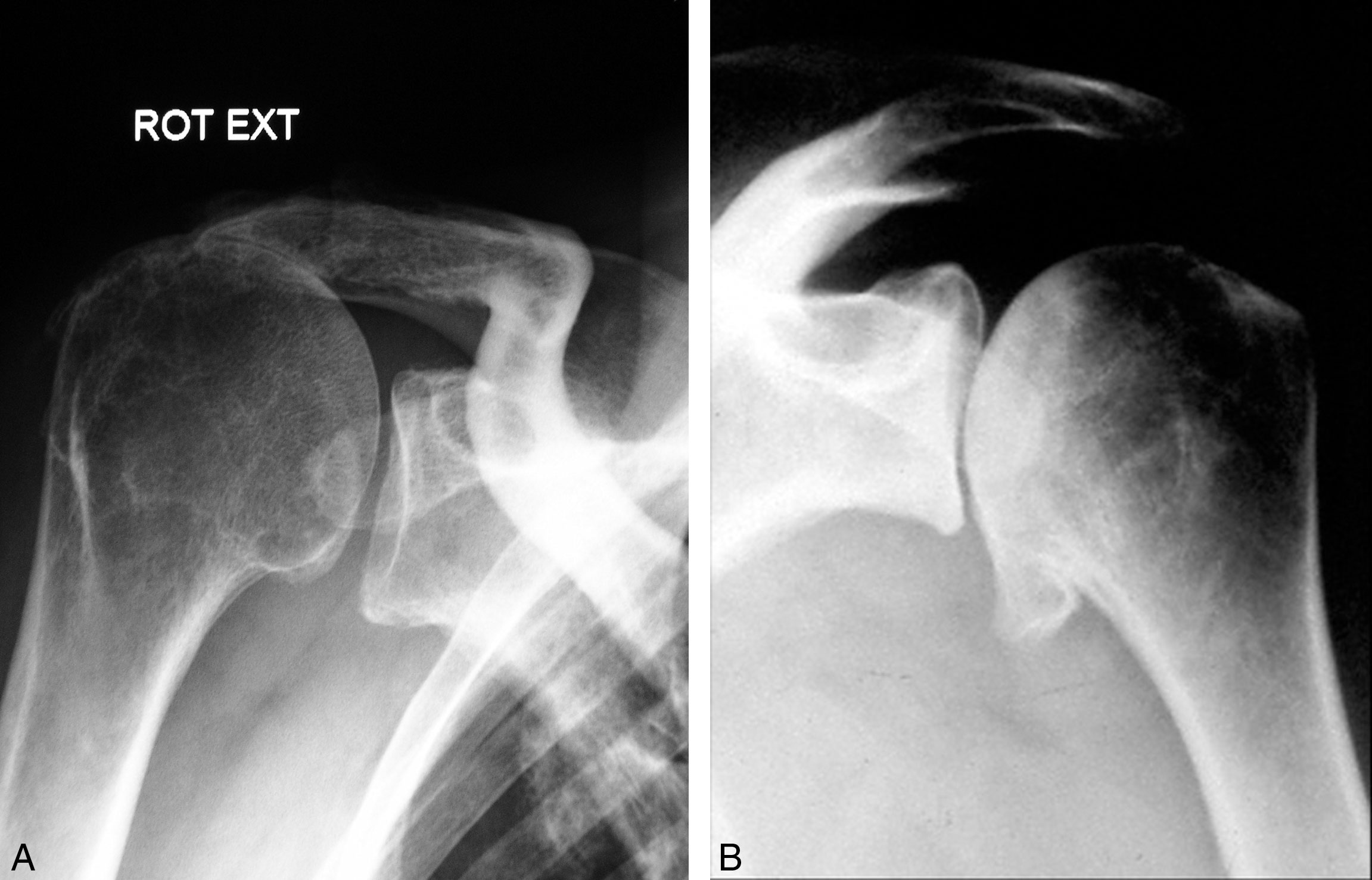 Définition, symptômes et diagnostic de l'arthrose de cheville