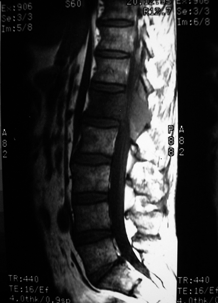 Compression médullaire non traumatique et syndrome de la queue de